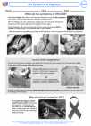 HIV Symptoms & Diagnosis